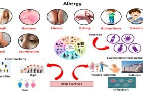 Allergy Immune Causes, Symptoms, Diagnosis & Treatment Guide
